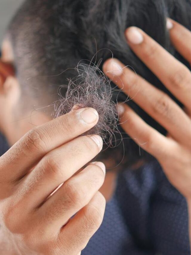 homem com calvície com queda de cabelo